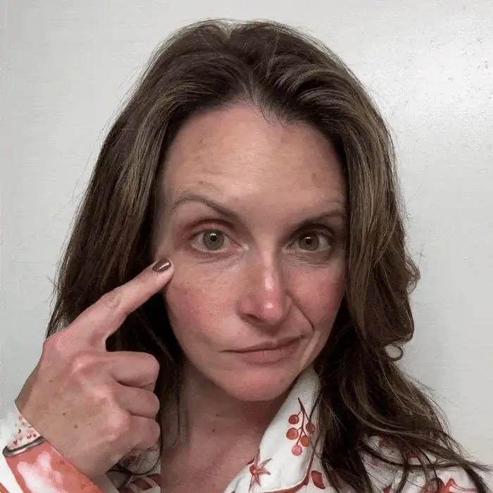 NovaLift microneedling patches in action